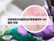 济南军区960医院治疗银屑病好吗 960医院 济南