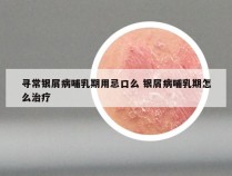 寻常银屑病哺乳期用忌口么 银屑病哺乳期怎么治疗