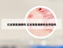 红皮银屑病痒吗 红皮银屑病痒吗会传染吗