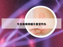 牛皮癣瘙痒睡不着觉咋办