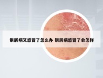 银屑病又感冒了怎么办 银屑病感冒了会怎样