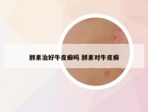 酵素治好牛皮癣吗 酵素对牛皮癣