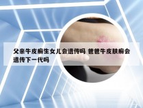 父亲牛皮癣生女儿会遗传吗 爸爸牛皮肤癣会遗传下一代吗