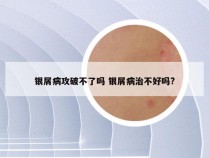 银屑病攻破不了吗 银屑病治不好吗?