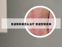 普通银屑病怎么治疗 普通型银屑病