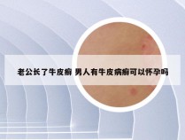 老公长了牛皮癣 男人有牛皮病癣可以怀孕吗
