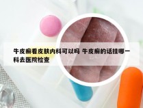 牛皮癣看皮肤内科可以吗 牛皮癣的话挂哪一科去医院检查