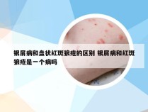 银屑病和盘状红斑狼疮的区别 银屑病和红斑狼疮是一个病吗