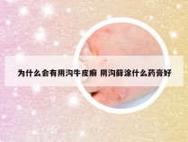 为什么会有阴沟牛皮癣 阴沟藓涂什么药膏好