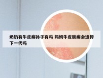 奶奶有牛皮癣孙子有吗 妈妈牛皮肤癣会遗传下一代吗