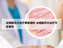 水杨酸可以治疗银屑病吗 水杨酸可以治疗牛皮癣吗