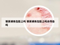 银屑病有在脸上吗 银屑病有在脸上吗会传染吗