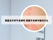 西医治不好牛皮癣吗 西医牛皮癣中医叫什么