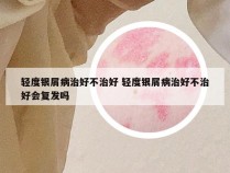 轻度银屑病治好不治好 轻度银屑病治好不治好会复发吗