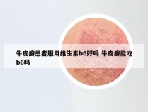 牛皮癣患者服用维生素b6好吗 牛皮癣能吃b6吗