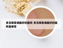 青岛银屑病最好的医院 青岛银屑病最好的医院是哪家
