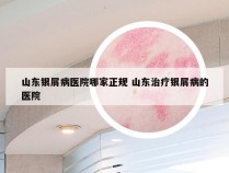山东银屑病医院哪家正规 山东治疗银屑病的医院