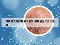 银屑病光疗好后多久复发 银屑病光疗几次见效