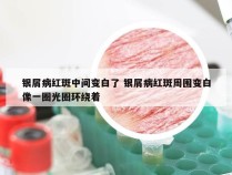 银屑病红斑中间变白了 银屑病红斑周围变白像一圈光圈环绕着