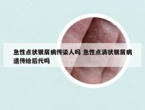 急性点状银屑病传染人吗 急性点滴状银屑病遗传给后代吗