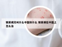 银屑病又叫什么中医称什么 银屑病在中医上怎么治