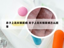 鼻子上出长银屑病 鼻子上出长银屑病怎么回事