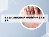 银屑病红斑有几种形状 银屑病的红斑怎么消下去