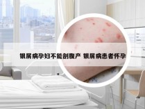 银屑病孕妇不能剖腹产 银屑病患者怀孕