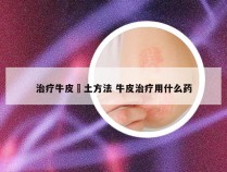 治疗牛皮廯土方法 牛皮治疗用什么药