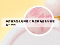 牛皮癣为什么对称着长 牛皮癣为什么对称着长一个包