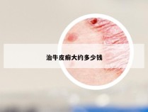 治牛皮癣大约多少钱