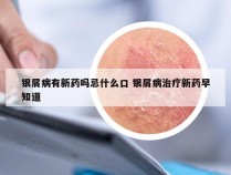 银屑病有新药吗忌什么口 银屑病治疗新药早知道