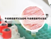 牛皮癣目前可以治愈吗 牛皮癣目前可以治愈吗