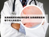 鱼鳞病跟银屑病能同时患吗 鱼鳞病跟银屑病哪个对人的危害大