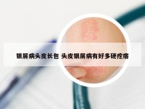 银屑病头皮长包 头皮银屑病有好多硬疙瘩