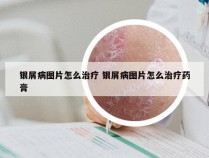 银屑病图片怎么治疗 银屑病图片怎么治疗药膏