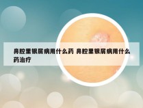 鼻腔里银屑病用什么药 鼻腔里银屑病用什么药治疗