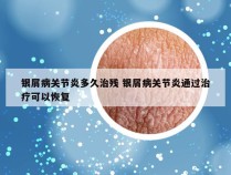 银屑病关节炎多久治残 银屑病关节炎通过治疗可以恢复