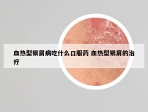 血热型银屑病吃什么口服药 血热型银屑的治疗