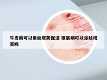 牛皮癣可以用丝塔芙保湿 银屑病可以涂丝塔芙吗