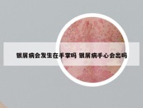 银屑病会发生在手掌吗 银屑病手心会出吗