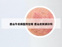 唐山牛皮癣医院在哪 唐山皮肤病诊所