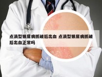 点滴型银屑病抓破后出血 点滴型银屑病抓破后出血正常吗