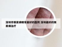 深圳市银屑病哪家最好的医院 深圳最好的银屑病治疗