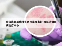 哈尔滨银屑病排名医院是哪家好 哈尔滨银屑病治疗中心