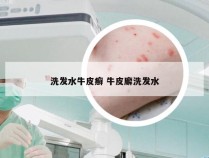 洗发水牛皮癣 牛皮廨洗发水