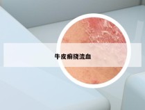 牛皮癣挠流血