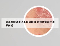 怎么办能让手上不长白癜风 怎样才能让手上不长毛