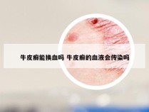 牛皮癣能换血吗 牛皮癣的血液会传染吗