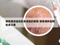 银屑病消退后色素减退的原因 银屑病恢复期色素沉着